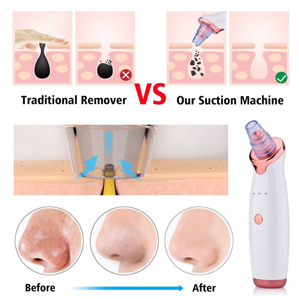 View details for Blackhead Electric Suction Facial Blackhead Electric Suction Facial