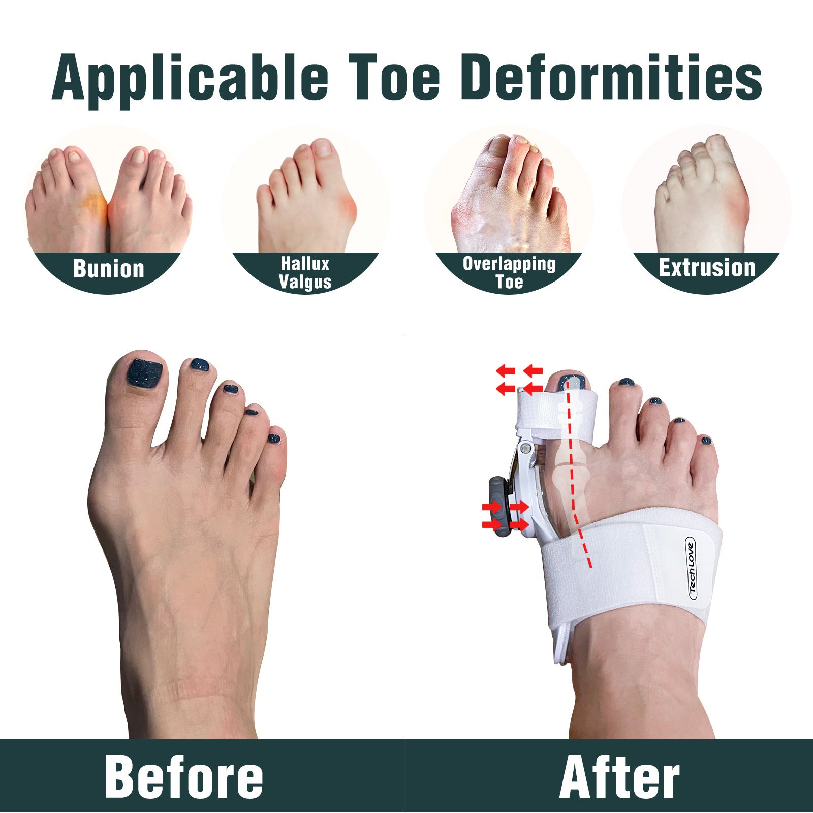  Toe Separator Night Toe Rectifier